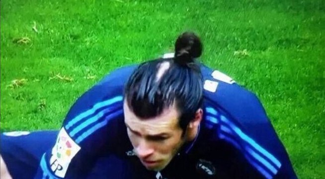 Gareth Bale's Bald Patch Revealed