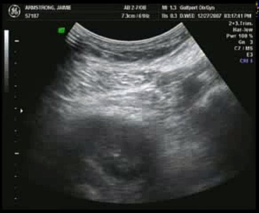 10 - week Ultrasound