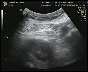 10 - week Ultrasound