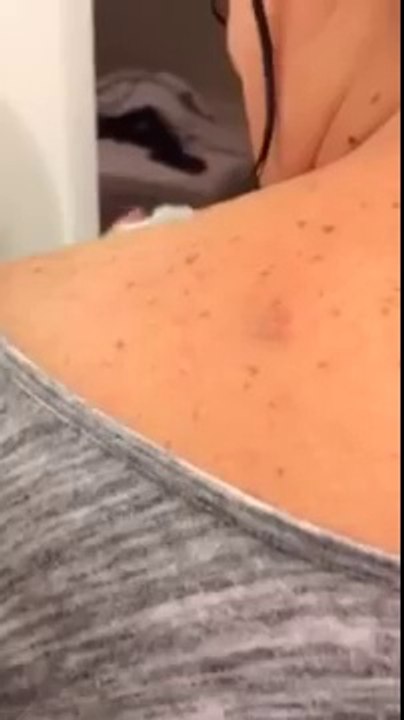 Huge Back Zit