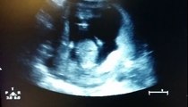 When The Doctor Saw This Ultrasound, He Was So Shocked He Told Them To Film It
