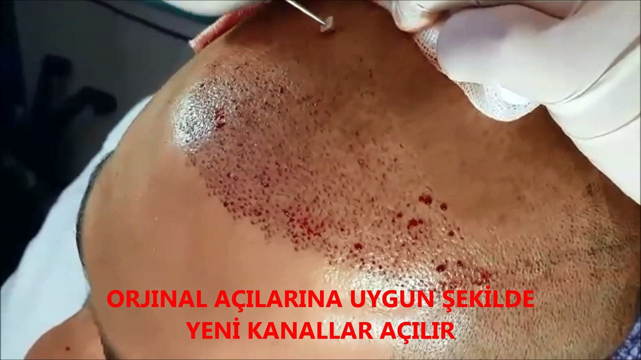 61- Saç ekimi aşamaları ve örnekler öncesi sonrası, hair transplantation, زرع الشعر,