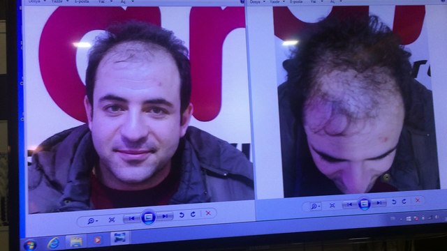 Saç ekimi aşamaları ve örnekler öncesi sonrası, hair transplantation, زرع الشعر,
