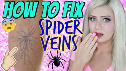 HOW TO FIX SPIDER VEINS ON YOUR LEGS