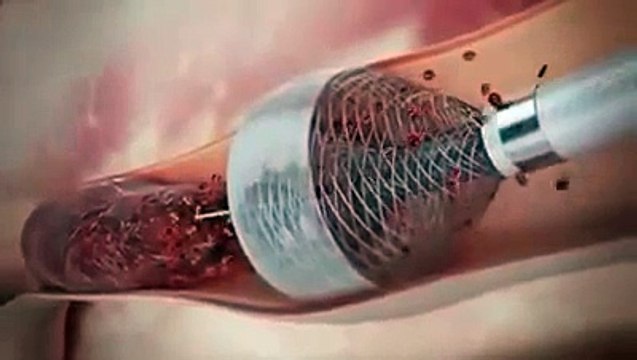 HEART SURGERY TRANSPLANTATION EASY WAY
