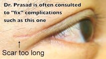 Asian Blepharoplasty Eyelid Surgery (double eyelid surgery) performed by eyelid surgery sp