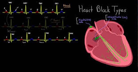 Understanding Heart Block Disease: Causes, Symptoms, and Treatment 🫀