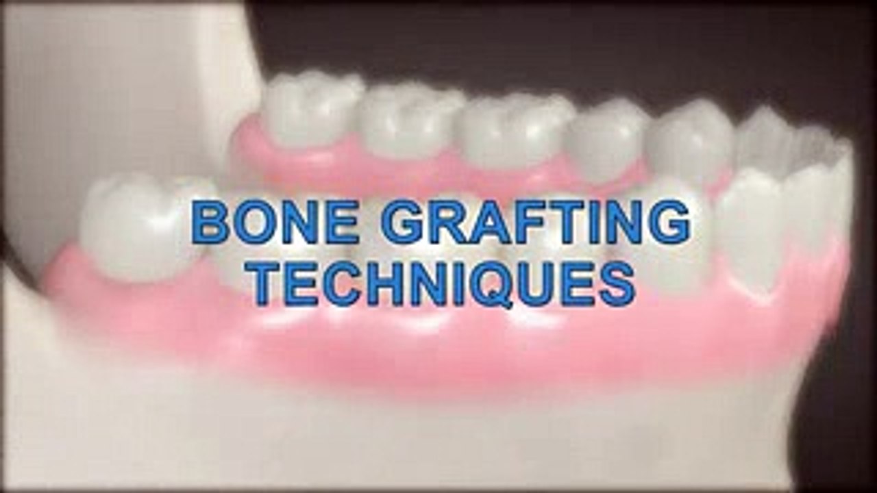 Dental Patient Education - Bone Graft For Dental Implant.