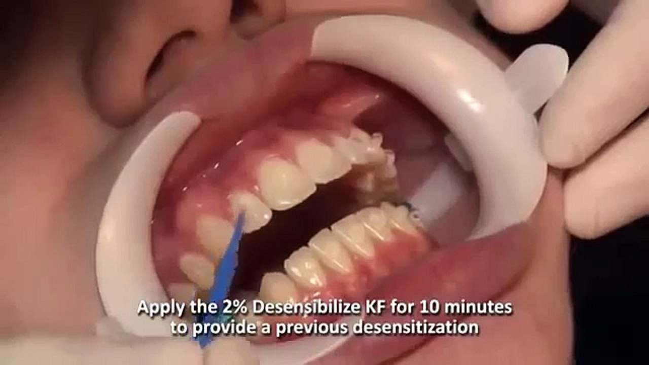 Quy trình tẩy trắng răng bằng Brite Smile - Nha khoa KIM