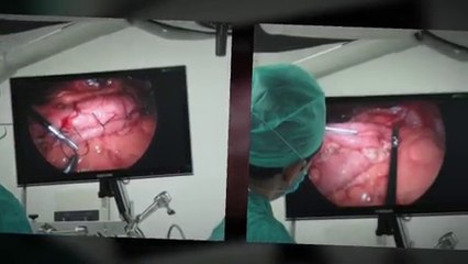 gastric plication   surgery