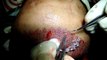 Hair Grafts Implantation during surgery at Natural Hair Transplant Clinic in  Ludhiana