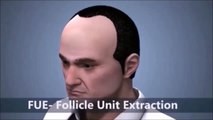 FUE Hair Transplant Procedure at Natural Hair Transplant in Ludhiana