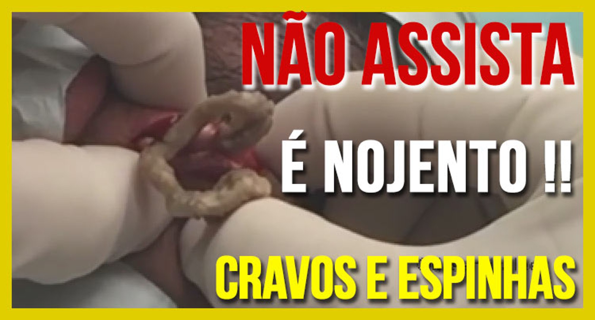 É proibido ver estes Cravos e Espinhas nojentos