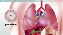 Tuberculosis: Diagnosis, Treatments & Latency