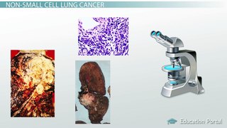 Lung Cancer: Causes, Signs & Treatments - Video & Lesson Transcript - Study.com