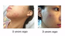 Remove Acne Marks - 3 Home Remedies (100% Works) With Results