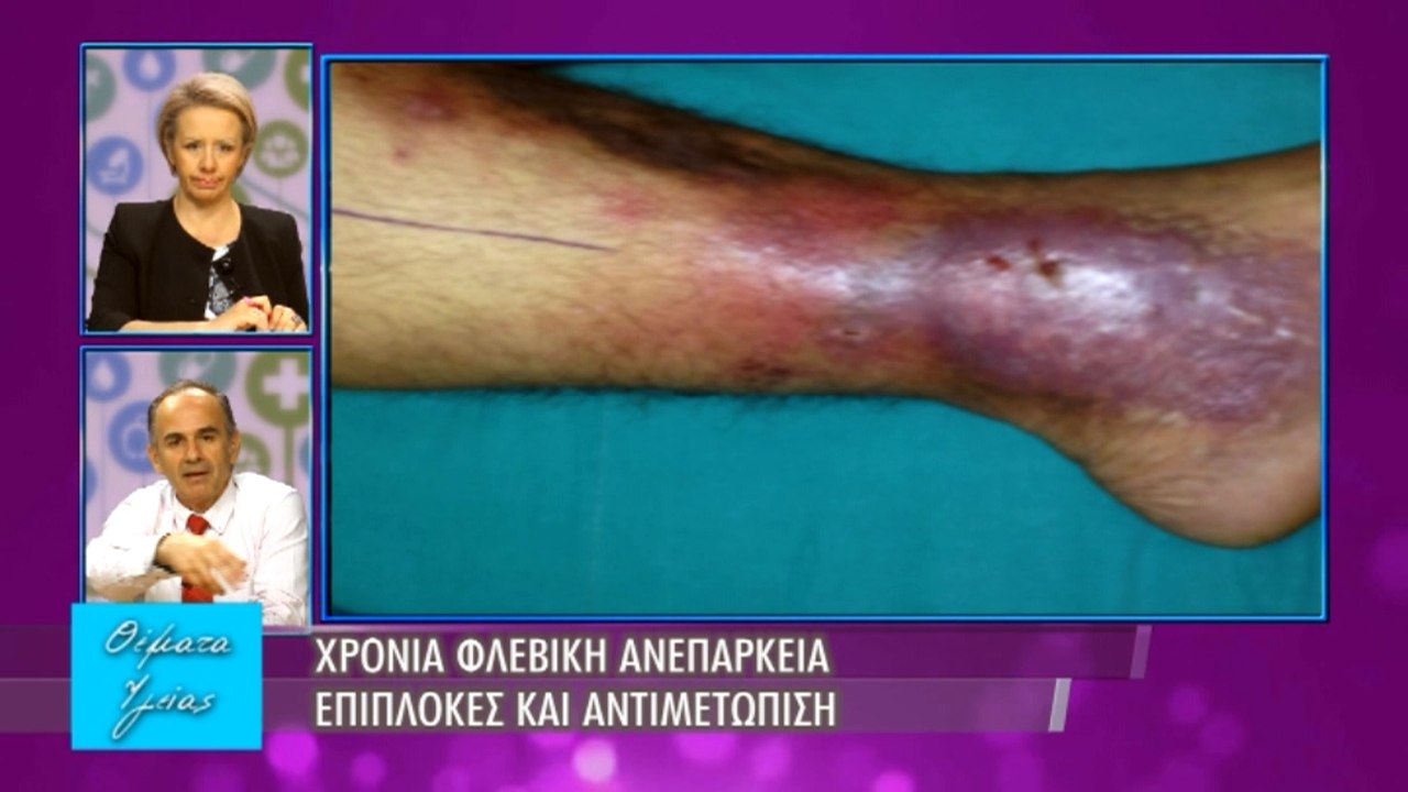 Υγείας Θέματα - Εκπομπή 16 - Φλεβική Ανεπάρκεια - Α' μέρος