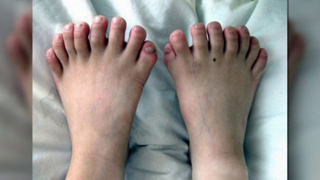 Chine : un bébé né avec 31 doigts et orteils