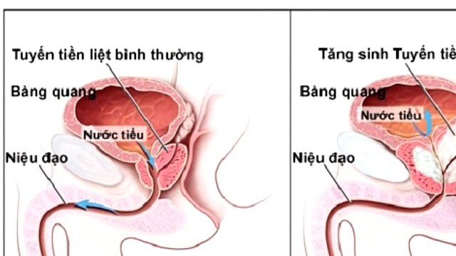 Bướu tiền liệt tuyến là bệnh gì?