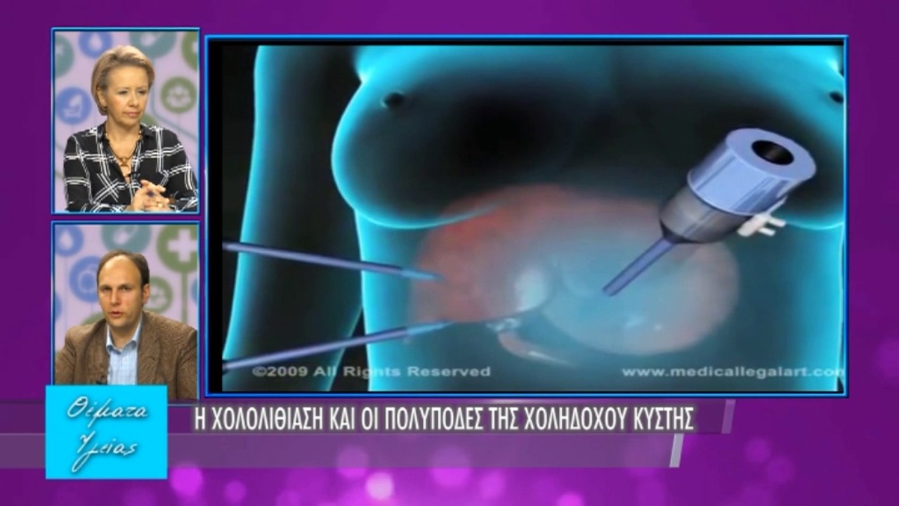 Υγείας Θέματα - Εκπομπή 19 - Χολολιθίαση - Β' μέρος
