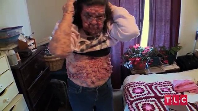 Bubble Gran, Woman Covered In Benign Tumours Body Bizarre Episode 5