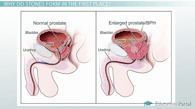 Kidney and Bladder Stones: Types, Causes, Signs & Treatments