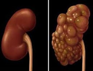 Polycystic kidney syndrome(PKD)