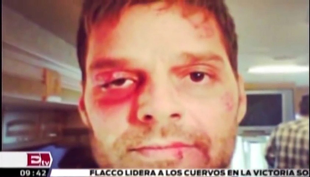 Ricky Martin muestra fotografias en las que aparece con mal aspecto