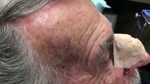 Blackheads, Cysts, White Heads Oh My!