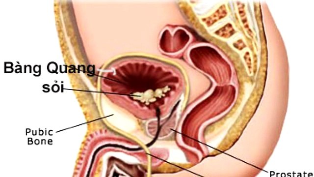 Bệnh phì đại tiền liệt tuyến có nguy hiểm?