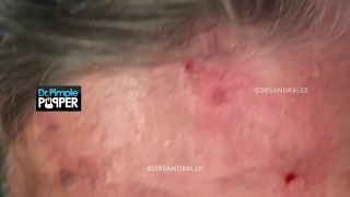 HD MILIA WHITEHEADS BIOPSY - New.mp4