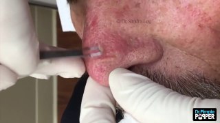 HD BLACKHEADS ON PRETTY BOY - New.mp4