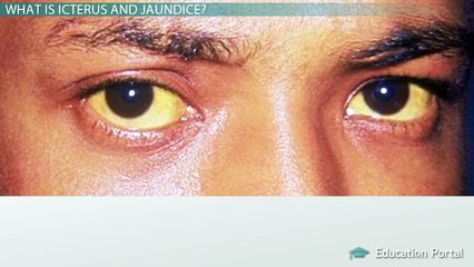 Icterus: The Major Causes of Jaundice