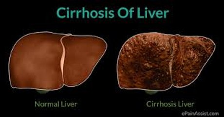 Cirrhosis of the Liver