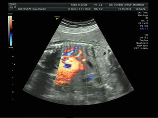 הריון שני - שבוע 23 סקירת מערכות מאוחרת 11.5.2016