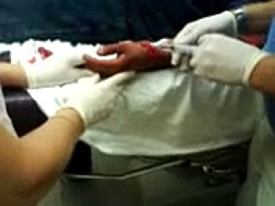 mi  accidente   casi  me  corto la mano