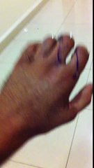 accidente mano aplastada