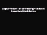 [PDF] Atopic Dermatitis: The Epidemiology Causes and Prevention of Atopic Eczema Read Full