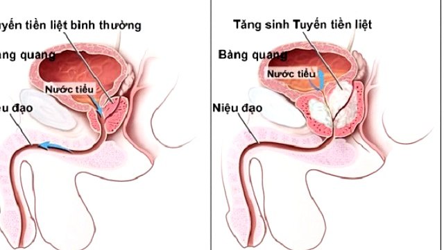 Ngăn ngừa ung thư tiền liệt tuyến nhờ xuất binh