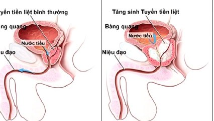 Những bệnh liên quan đến tuyến tiền liệt