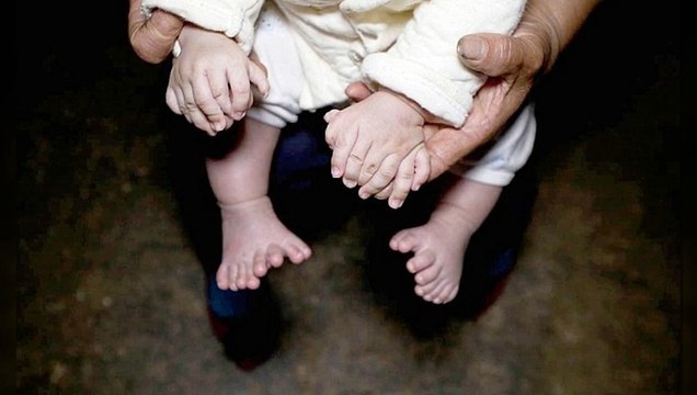 Ce bébé chinois est né avec 31 doigts et orteils !