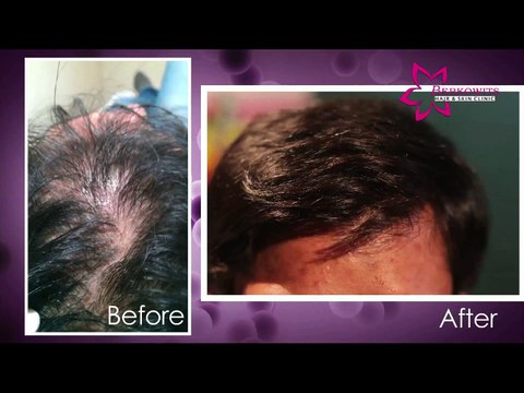 Hair Treatment Services, Hair Treatment,Hair Treatment Delhi,Hair Treatment India