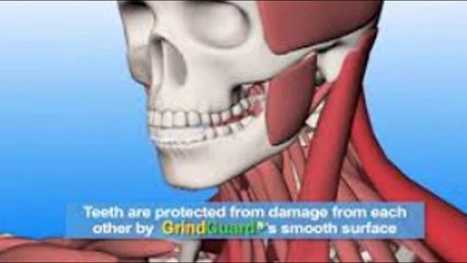 best solution for Teeth Grinding