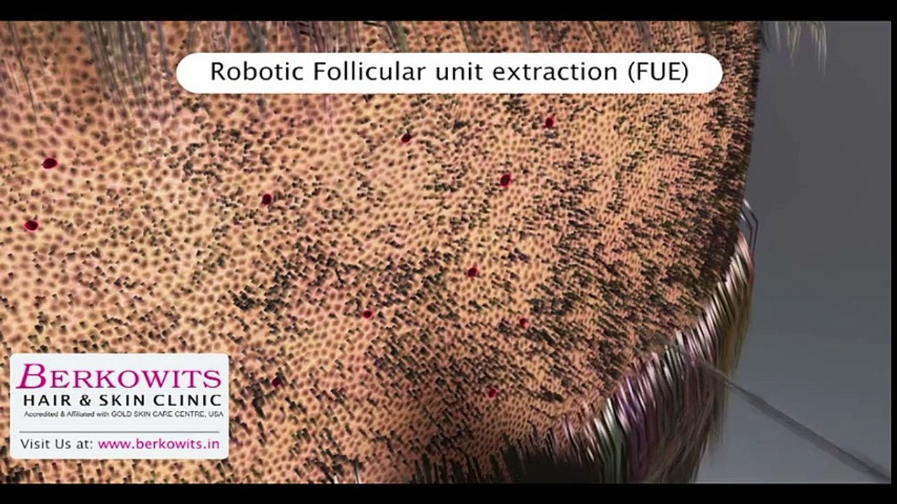 Robotic Hair Transplant Delhi, Robotic Hair Transplant india,Robotic Hair Transplant services, Robotic Hair Transplant