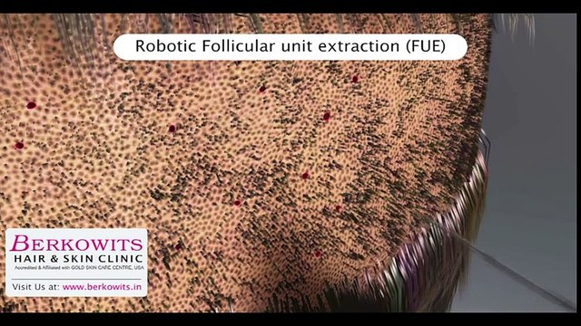 Robotic Hair Transplant Delhi, Robotic Hair Transplant india,Robotic Hair Transplant services, Robotic Hair Transplant