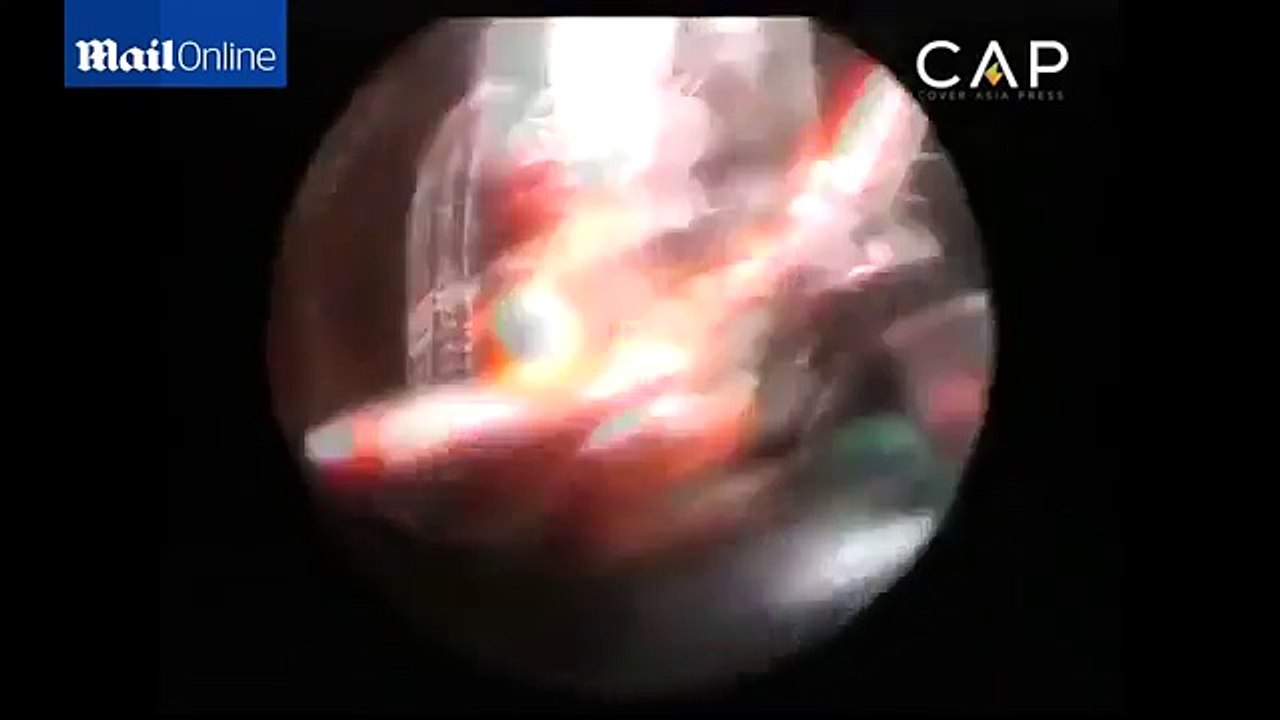 سبحان الله شاهد نمل كبير الحجم يعيش داخل أذني طفلة فى مشهد عجيب جداً