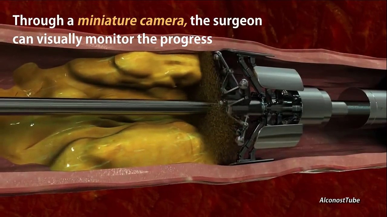 A Machine That Can Remove Cholesterol Plaques.