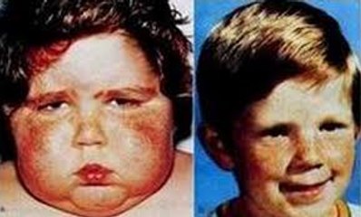 Cushing's Syndrome. What is cushing's disease?