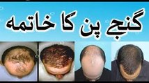 how to control hair fall - ganjapan ka desi ilaj in urdu hindi