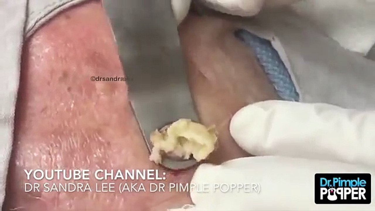 Il a cet énorme truc sur la tête depuis des années, la médecin le crève enfin. Ce qui sort de là? OH MON DIEU!